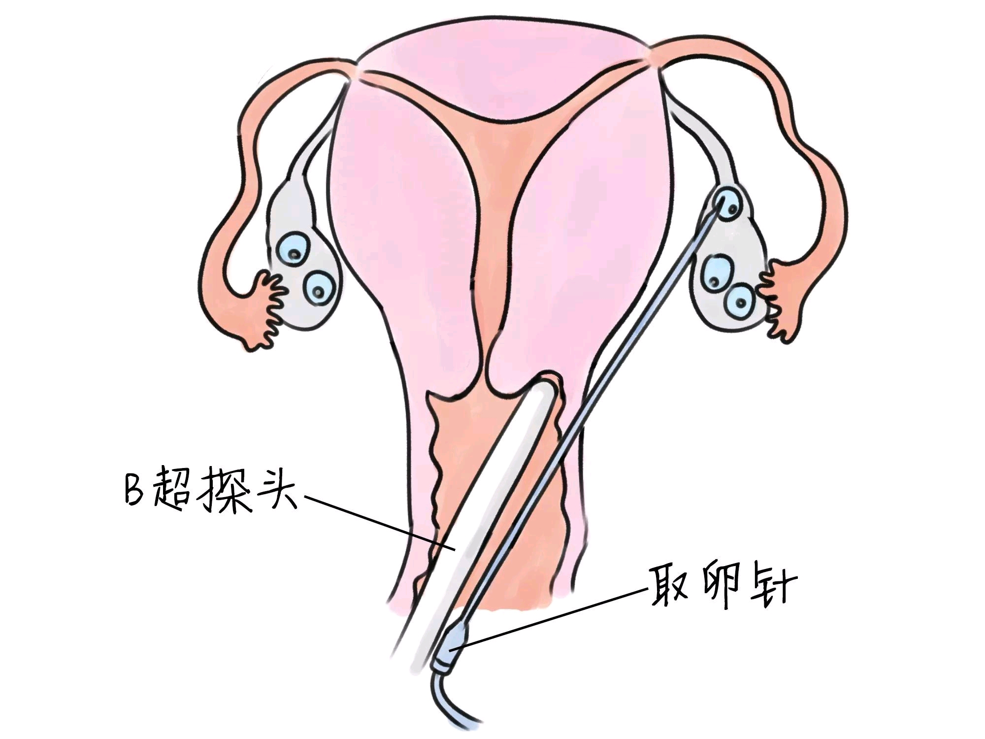 孕妇晚期贫血