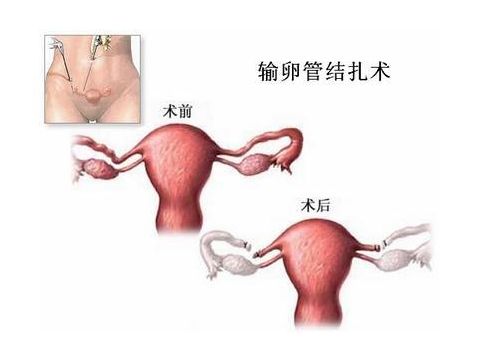 早孕呕吐